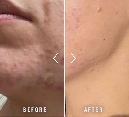 PanOxyl Acne Foaming Wash Benzoyl Peroxide 10% Maximum Strength Antimicrobial 5.5 Oz (Pack of 2)