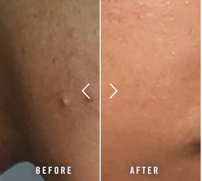 PanOxyl Acne Foaming Wash Benzoyl Peroxide 10% Maximum Strength Antimicrobial 5.5 Oz (Pack of 2)