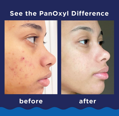PanOxyl Acne Foaming Wash Benzoyl Peroxide 10% Maximum Strength Antimicrobial 5.5 Oz (Pack of 2)